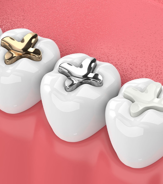 composite fillings Frisco