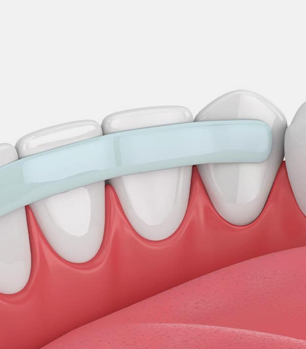 dental bonding Frisco