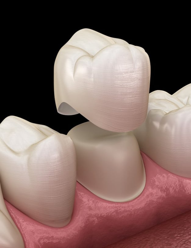 dental crowns Frisco
