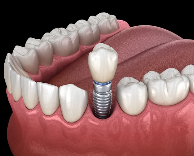 dental implants Frisco