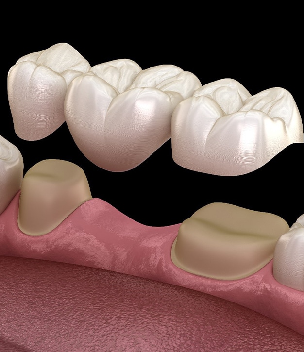 dental bridges Frisco