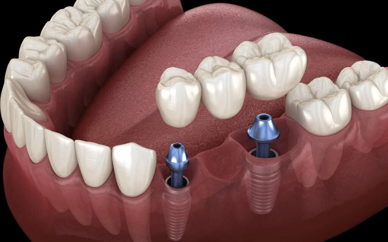 How Advanced Technology Improves Dental Implant