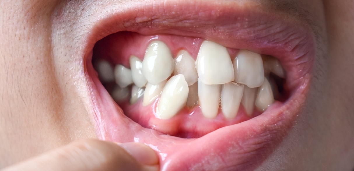 Can Cosmetic Dentistry Fix an Overbite